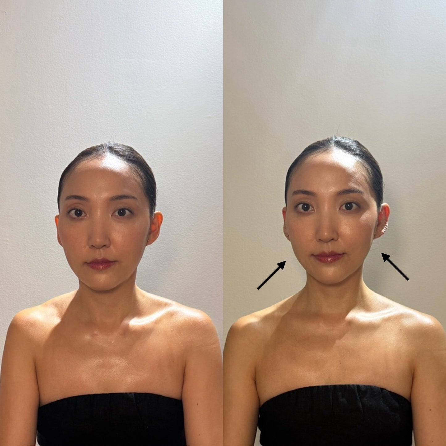 V-LINE EAR SEED KIT